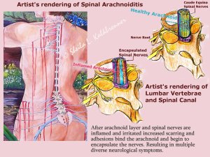 Artist's Rendering of Spinal Arachnoiditis 